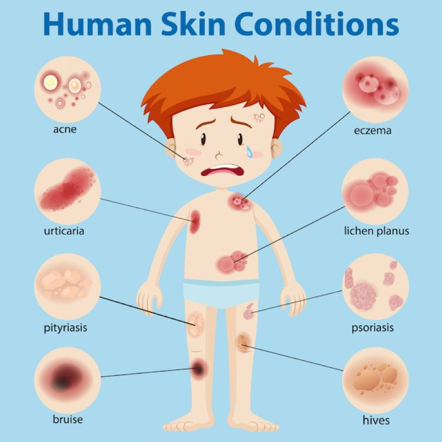 Common Skin Conditions in Children: Identifying and Managing Rashes, Eczema, and Acne