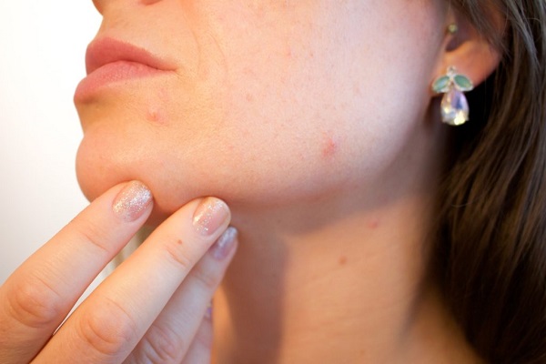 Best New Acne treatment in 2019: Seysara