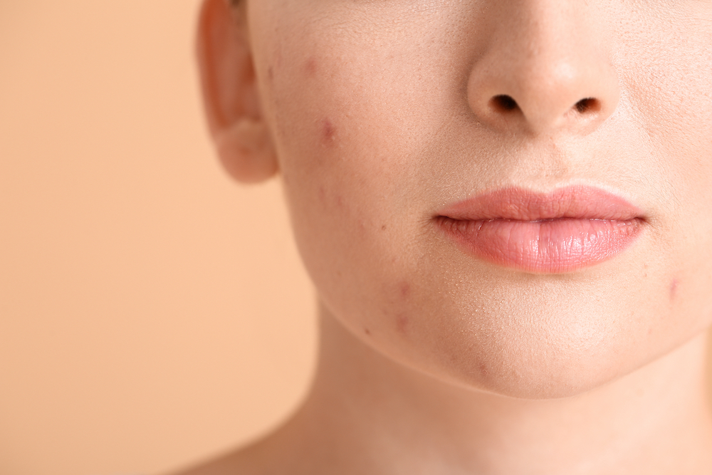Understanding Acne and How to Treat the Different Types