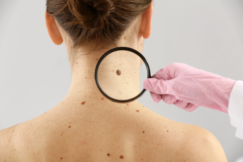 Early Detection and Prevention of Melanoma: How to Protect Your Skin