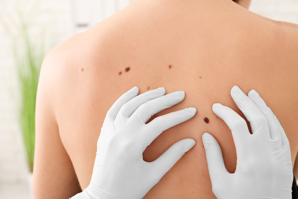 Superficial Radiation Therapy for Skin Cancer: How It Works and Its Role in Treatment