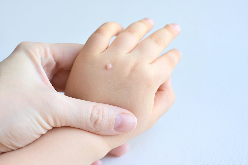 FAQs about wart removal using Swift treatment