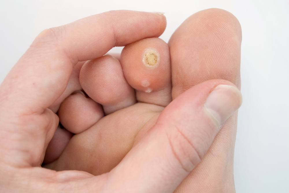 Top 5 Benefits of Swift for Wart Treatment