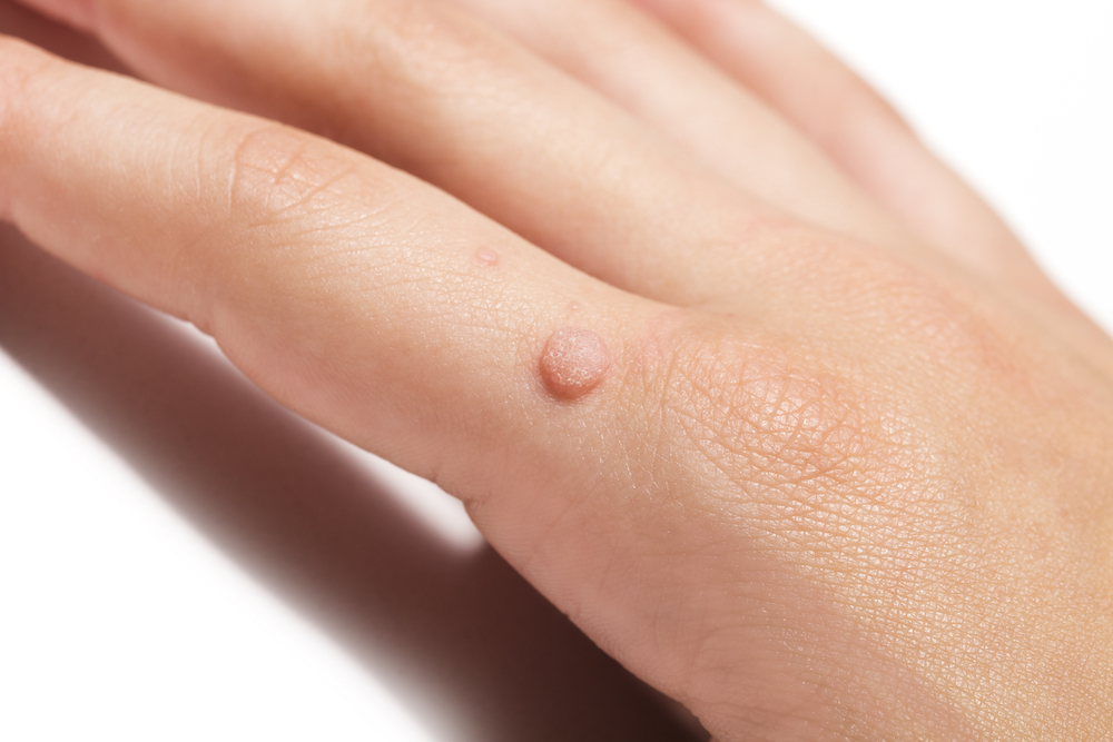 What Is Swift®, and How Does It Remove Warts?
