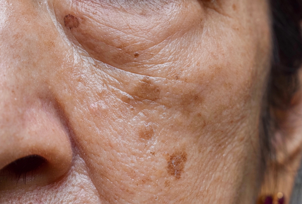 How UltraClear® CO2 Laser Treatments Can Reverse Sun Damage and Age Spots