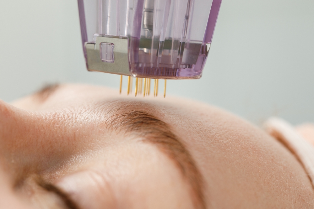 Benefits of Combining Fillers and Microneedling for Full Correction