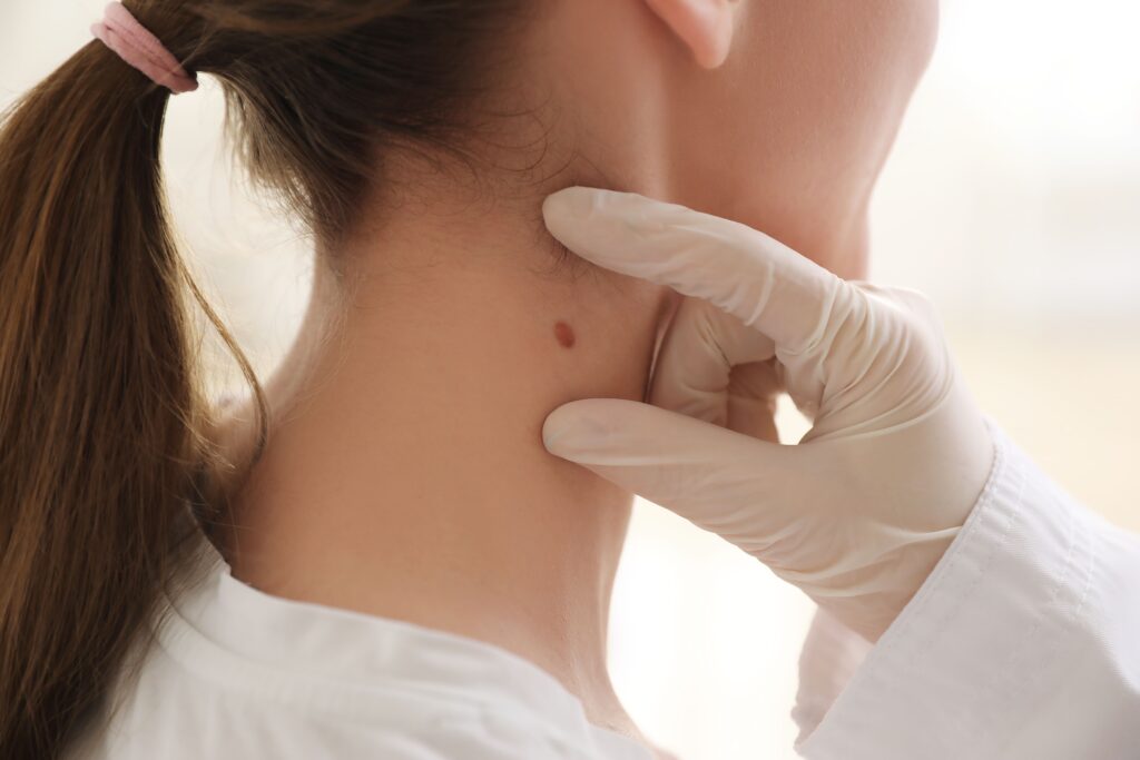 New or Changing Moles: What They Could Mean for Your Skin Health