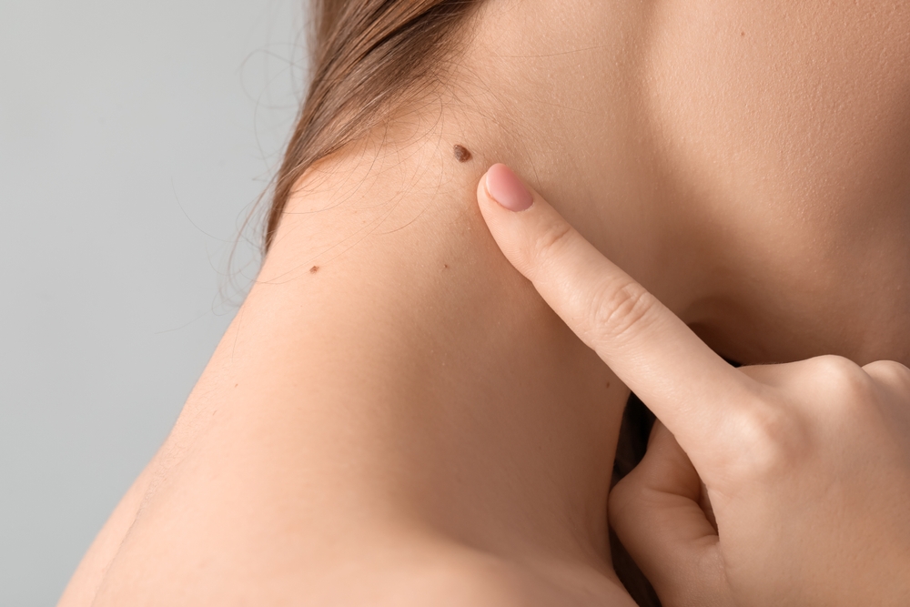 Recognizing the Signs of Skin Cancer: When to Schedule a Screening