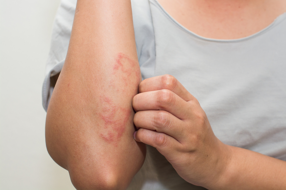 Biologic Therapy for Psoriasis: Modern Relief for a Chronic Condition