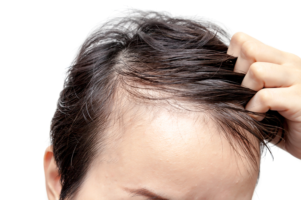 Hair Loss and Confidence: How Scalp PRP Can Help