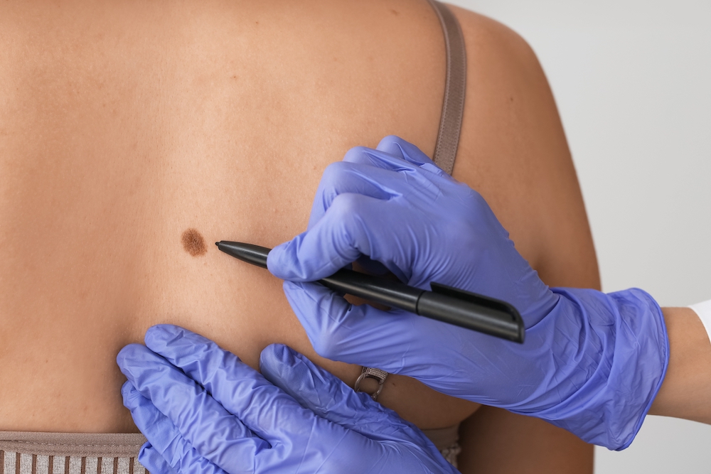 Deciding on the Best Skin Cancer Treatment? SRT for the Win!