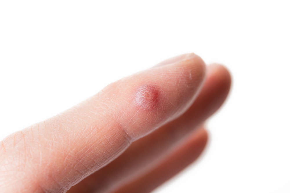 Why Swift® Wart Removal is Better Than Over-the-Counter Options